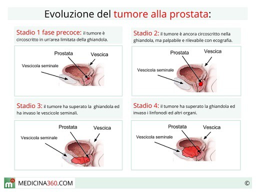 tumore-alla-prostata